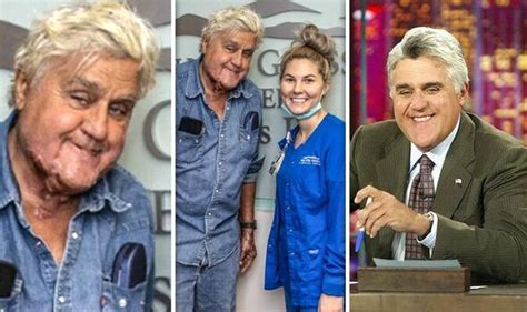 Jay Leno Pictured Leaving Hospital After Suffering Serious Facial