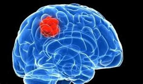 10 Facts About Brain Cancer Fact File