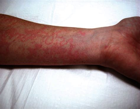 Erythema Marginatum On The Arm Of A Patient With Hereditary