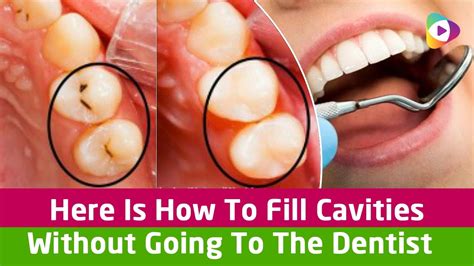 Plaque naturally collects in your mouth, even. Here Is How To Fill Cavities Without Going To The Dentist ...