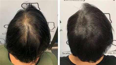 Scalp Micropigmentation For Women Hair Loss Treatment To Conceal