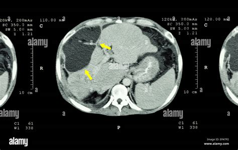 Ct Scan Of Upper Abdomen Show Abnormal Mass At Liver Liver Cancer