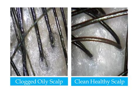 Aggregate 79 Clogged Hair Follicle Best Ineteachers