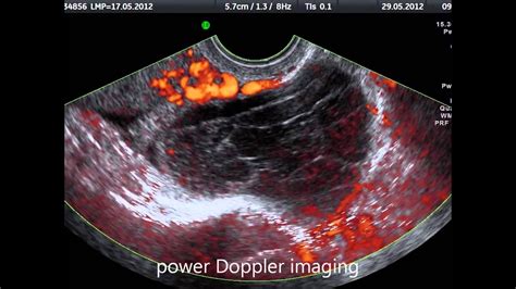 Hemorrhagic Ovarian Cyst On Transvaginal Ultrasound Youtube