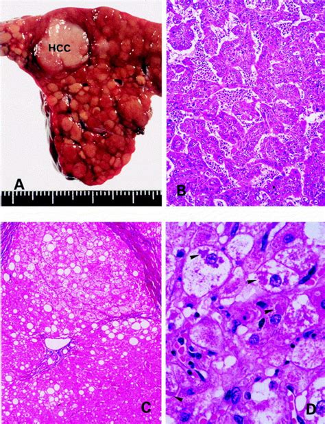 Hepatocellular Carcinoma In Patients With Non Alcoholic Steatohepatitis