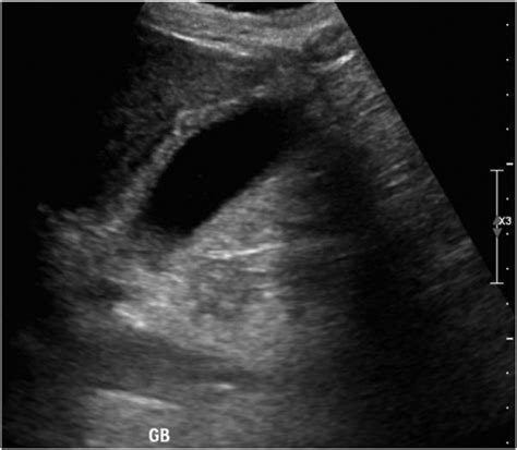 Longitudinal View Of Gallbladder On Ultrasound Showing Diffusely