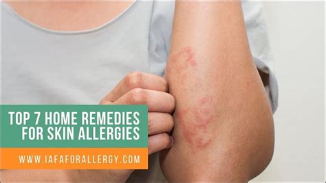 Top 7 Home Remedies For Skin Allergies Ayurvedic Treatment