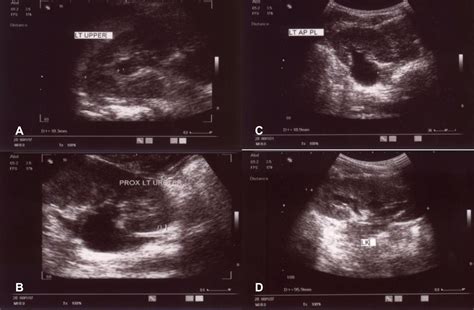 Cureus Fibroepithelial Polyp In A Child A Rare Pathology Of Upper