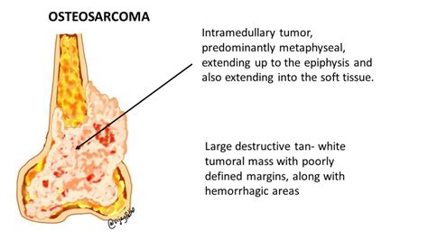 Osteosarcoma Pathological Features Pathology Made Simple