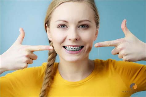 How Much Do Braces Cost In South Africa Find Out The Price Here April 2024
