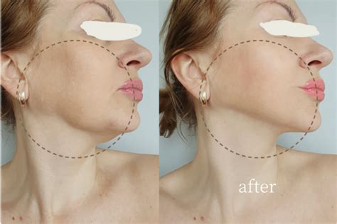Thread Lift Before And After Jowls Rejuvenate Your Appearance
