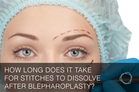 If done by a trained ophthalmic plastic surgeon the surgery has excellent success rates. How long does it take for stitches to dissolve after ...