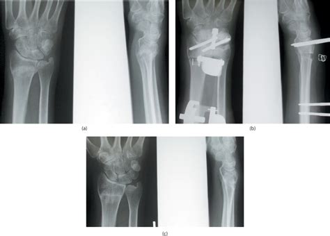 Distal Radius And Ulnar Fractures Musculoskeletal Key