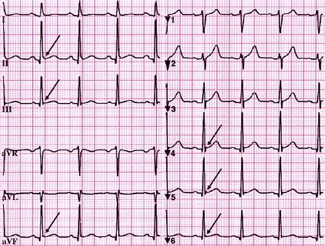 Ekg St Elevation Leads