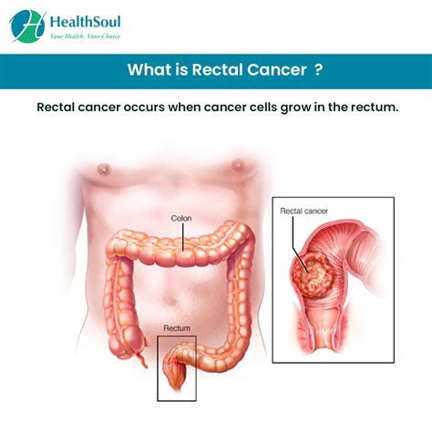Rectal Cancer Dont Ignore The Early Signs Healthsoul