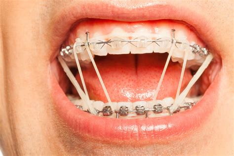 Overbite Braces Rubber Bands
