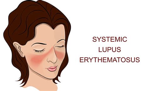 What Causes A Lupus Butterfly Rash