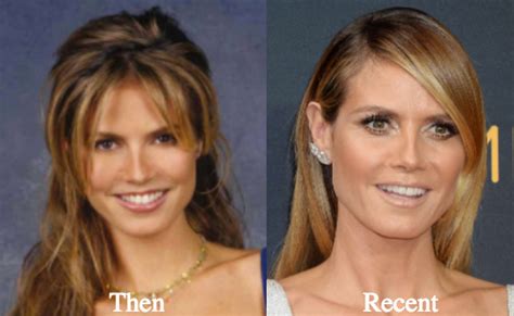 Heidi Klum Plastic Surgery Before And After Photos