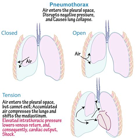 Tension Pneumothorax Diagram