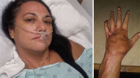 Papercut On Us Womans Pinky Finger Leads To Sepsis Necrotising Fasciitis 7news