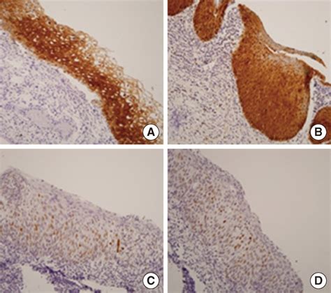 Immunohistochemical Studies For P16 A B And P53 C D In Cervical