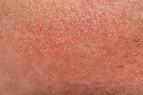 Manifestations Of An Allergic Reaction To The Sun Photodermatitis
