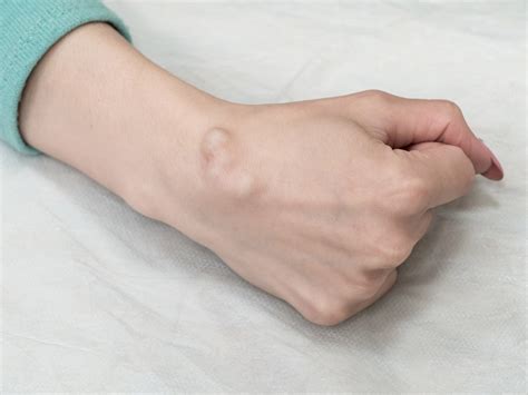 Types Of Skin Cysts And Treatment Options Lymphatic And Endocrine