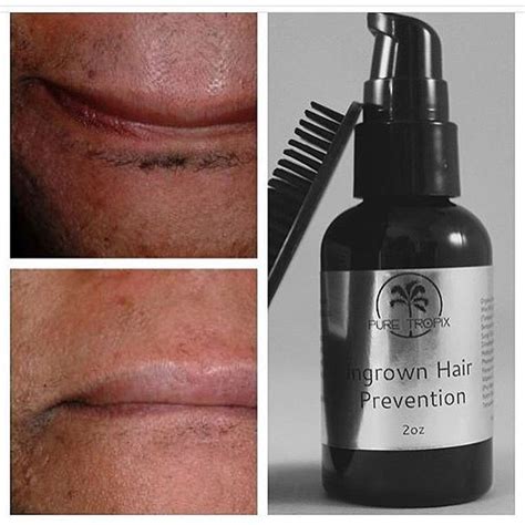 Remove dark spots from razor bumps & ingrown hairs #ingrownhairbumps. Our all natural product gets rid of ingrown hairs and dark ...