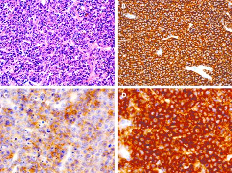 A Diffuse Large B Cell Lymphoma In The Second Specimen Hande B