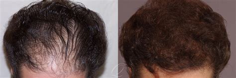 Female FUT Hair Transplant Before After Photos Patient 1049 Serving