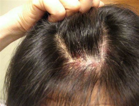 Red Spots On Scalp And Hair Loss