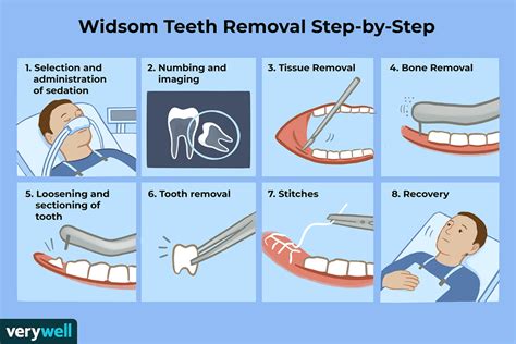 Foods should be restricted to a liquid diet until all the numbness from anesthesia has worn off. Chirurgie d'extraction des dents de sagesse : Préparation ...