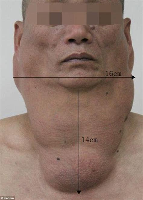 Chinese Alcoholic Develops Fat Deposits Around His Throat After