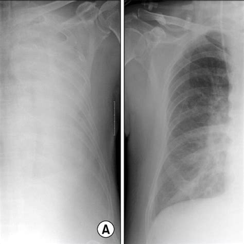 Chest X Ray A The Chest X Ray Shows Total Atelectasis Of Left Lung Download Scientific