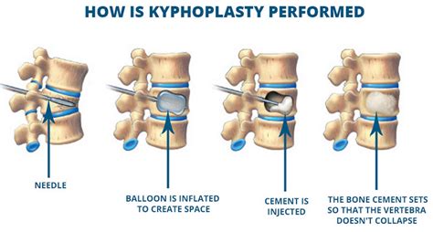 Kyphoplasty Procedure How Kyphoplasty Is Done And Kyphoplasty Risks