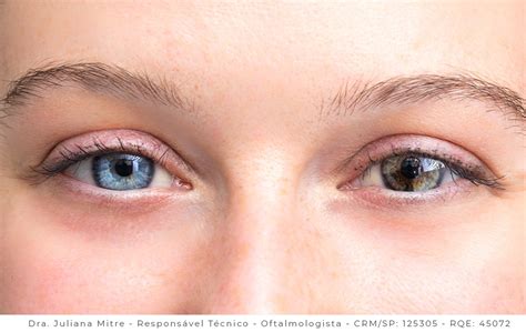 Heterocromia O Que é