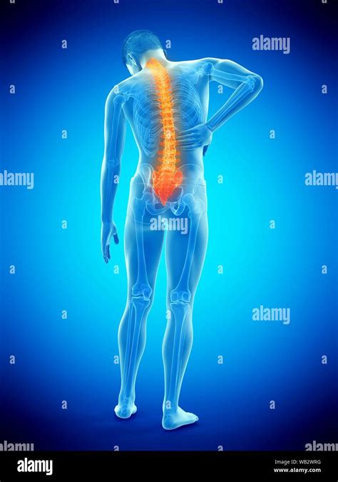 Back Pain Conceptual Illustration Stock Photo Alamy