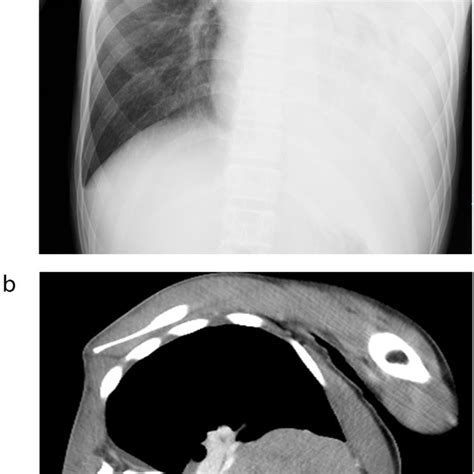 A Chest X Ray Showing An Enlarged Mediastinal Shadow Left