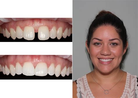 Palm Beach Smiles Cosmetic Dentistry And 6 Month Braces Do You Mind
