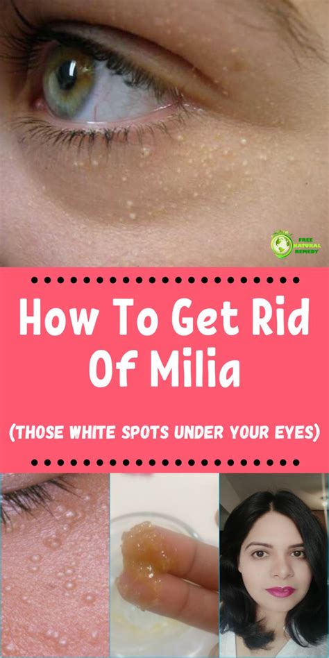 How To Get Rid Of Milia Those White Spots Under Your Eyes Home