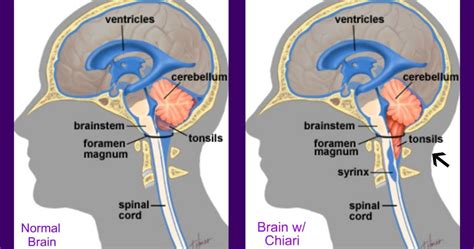 Hanging Low And Invisible What Is Chiari