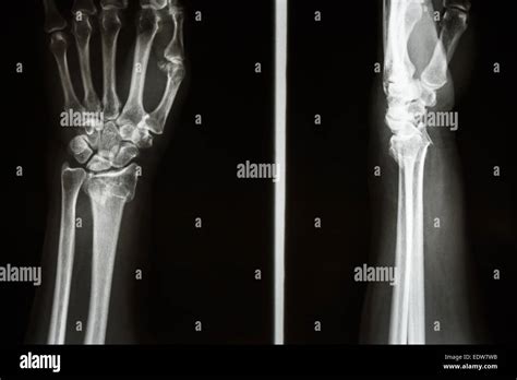 Film X Ray Show Fracture Distal Radius Colles Fracture Wrist Stock