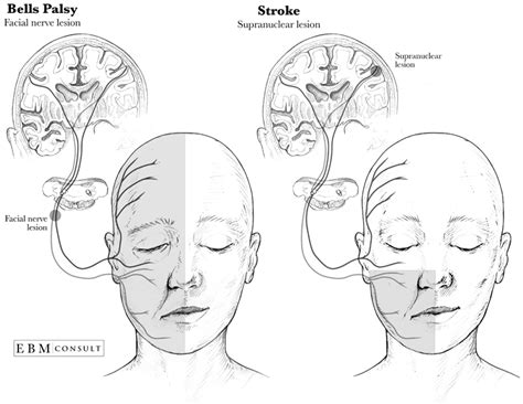 The weakness makes half of your face appear to droop. Understanding Bell's Palsy: Symptoms, Causes and Treatment ...