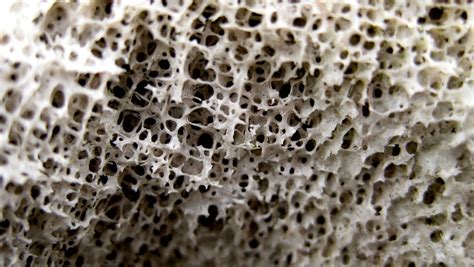 What if we could create custom bone implants that would trigger their own replacement with real bone? Osteoporosis risk predicted with genetic test - Scope