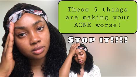 5 Mistakes Making Your Acne Worse In 2023 Youtube