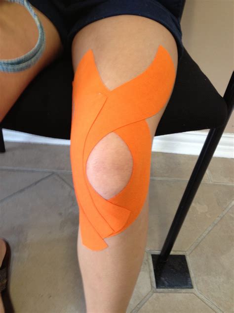 Tape In The Management Of Patellofemoral Pain Claire Patella