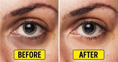 Get Rid Of Dark Circles Dermatologists And Makeup Artists Weigh In On