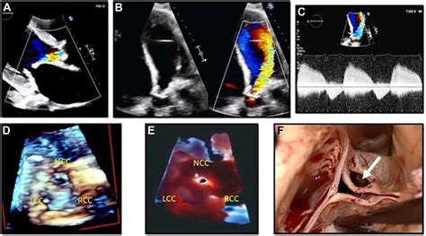 Clinical Utility Of Transillumination On Transthoracic Imaging Case