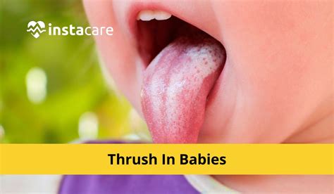 Oral Thrush In Babies Symptoms Causes And Treatments