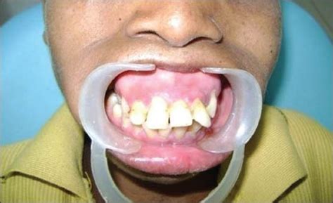 Patient Presenting Typical Chipmunk Facies Along With Malaligned Teeth